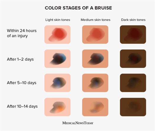 Infographic showing bruise color development on different skin tones